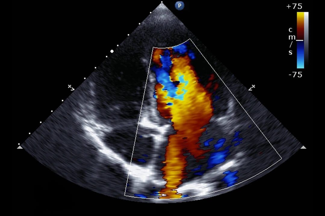Renkli Doppler Nedir? Neden Yapılır?